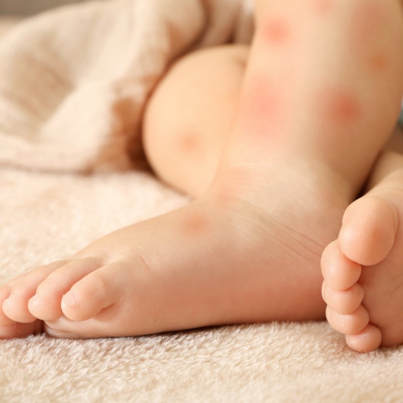 Почему появляется сыпь на попе у ребенка?